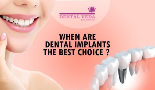 When are Dental Implants the Best Choice