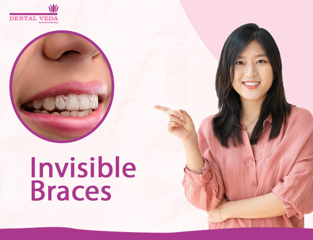 Invisible Braces For Teeth - What and How They Work ?