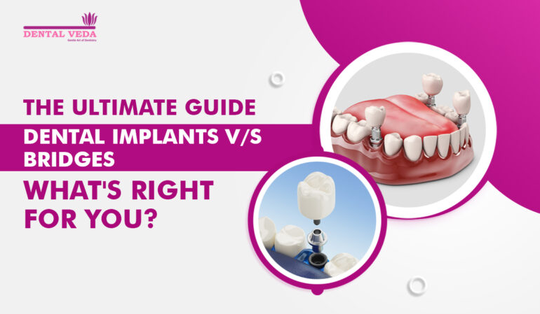 The Ultimate Guide: Dental Implants vs. Bridges - What's Right for You?