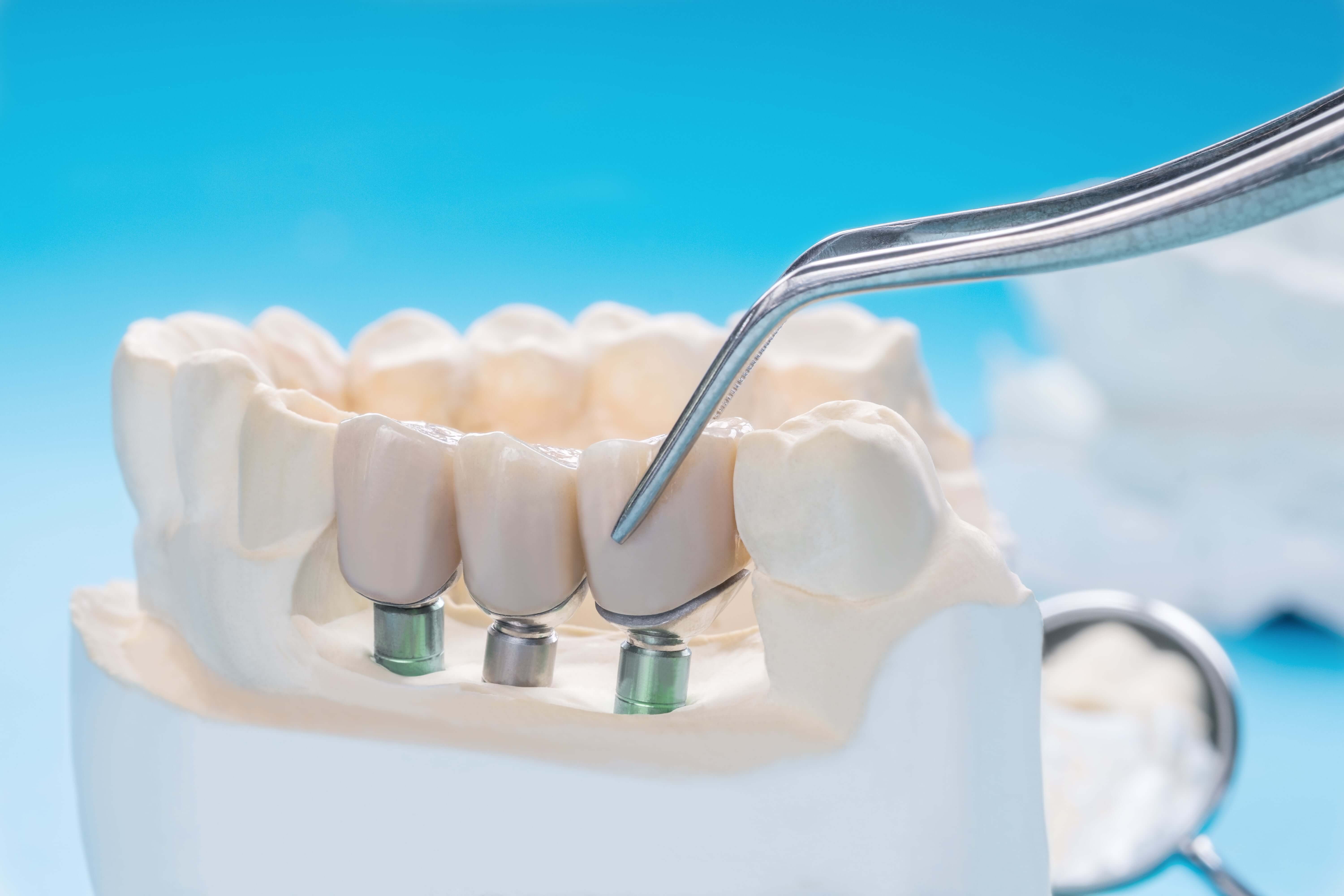 Как называется протезист. Имплантация зубов мостовидные протезы. Имплант стоматология. Стоматологические коронки. Красивые зубы стоматология.